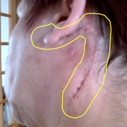Cicatrice sans les fils de suture (lipome)